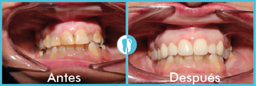 Clínica Dental Dra. Montero tratamiento de odontología 2 antes y después