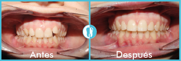 Clínica Dental Dra. Montero tratamiento de odontología 3 antes y después