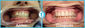 Clínica Dental Dra. Montero tratamiento de odontología 1 antes y después