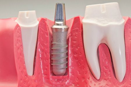  Clínica Dental Dra. Montero implante dental 
