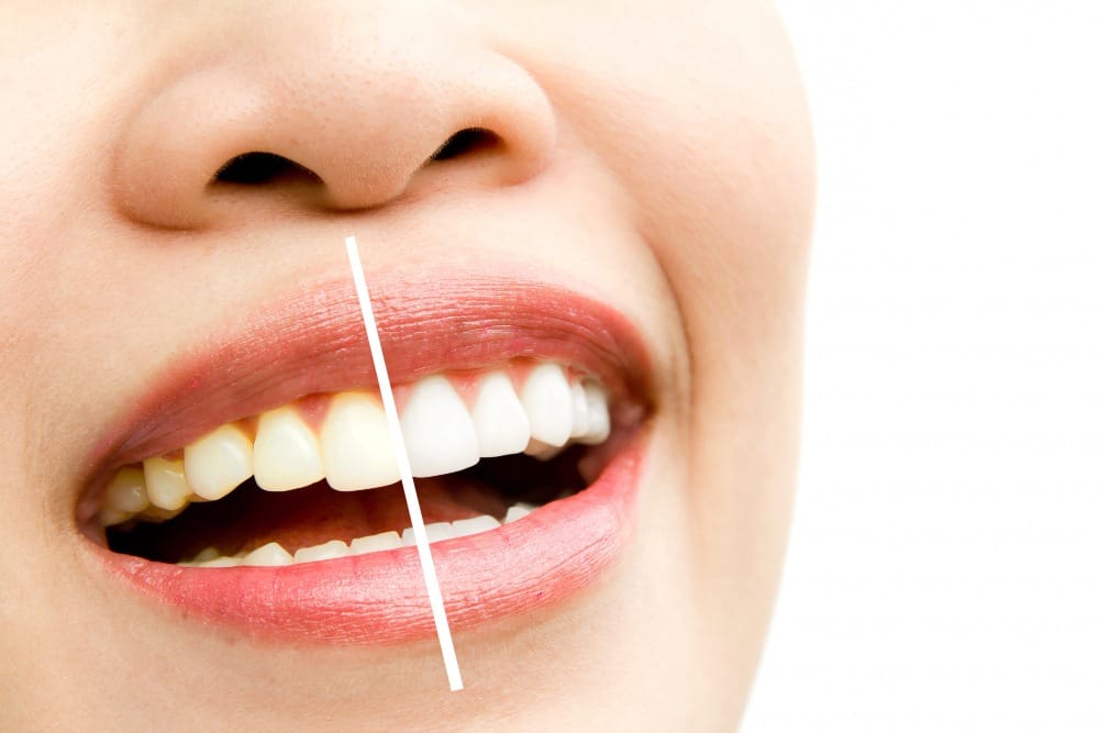 Blanqueamiento dental en Dos Hermanas, Sevilla - Dra. Montero